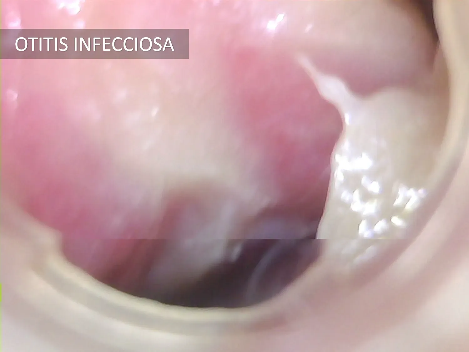 Otorrinolaringología